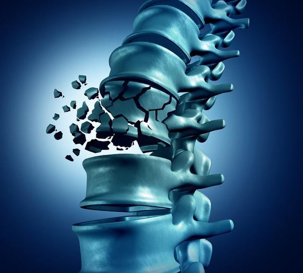 五類骨質疏松高發人群 有必要檢測骨密度